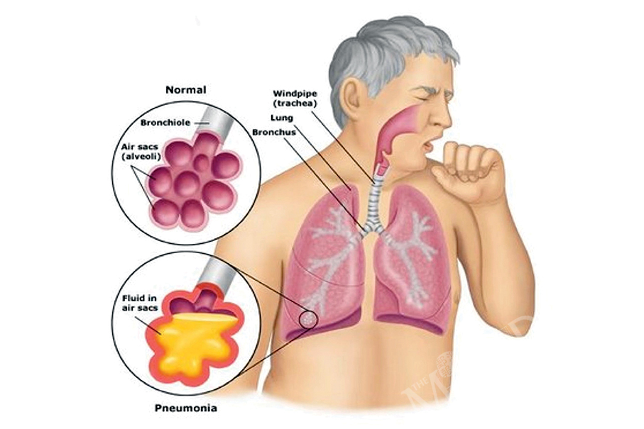 Health Bureau reports this year’s 2nd local case of Legionnaires’ disease 