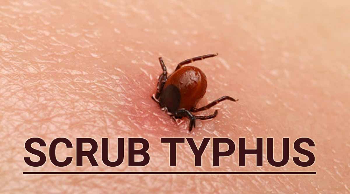 Health Bureau reports another case of scrub typhus 