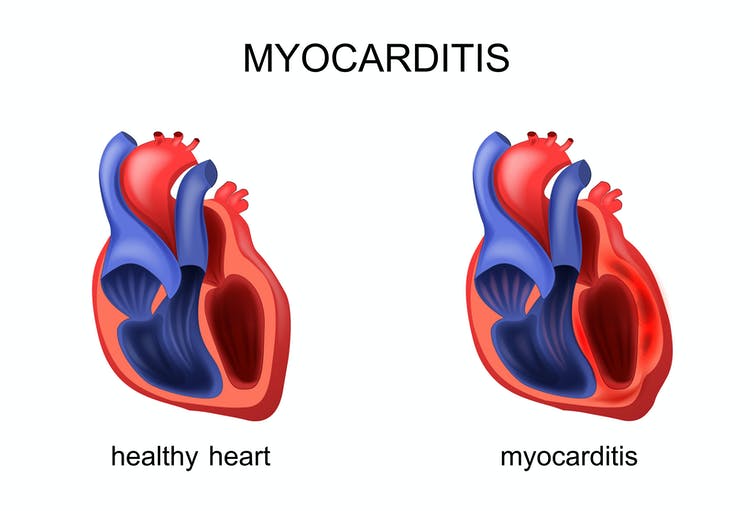 Man suffers inflammatory cardiomyopathy post-COVID-19 jab: SSM