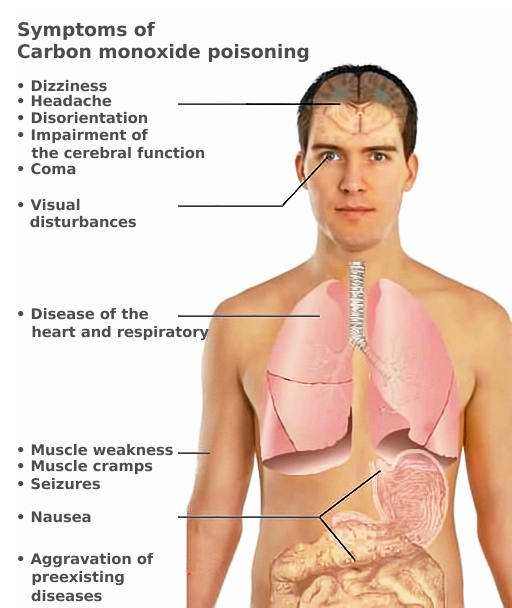 Another carbon monoxide poisoning case: SSM