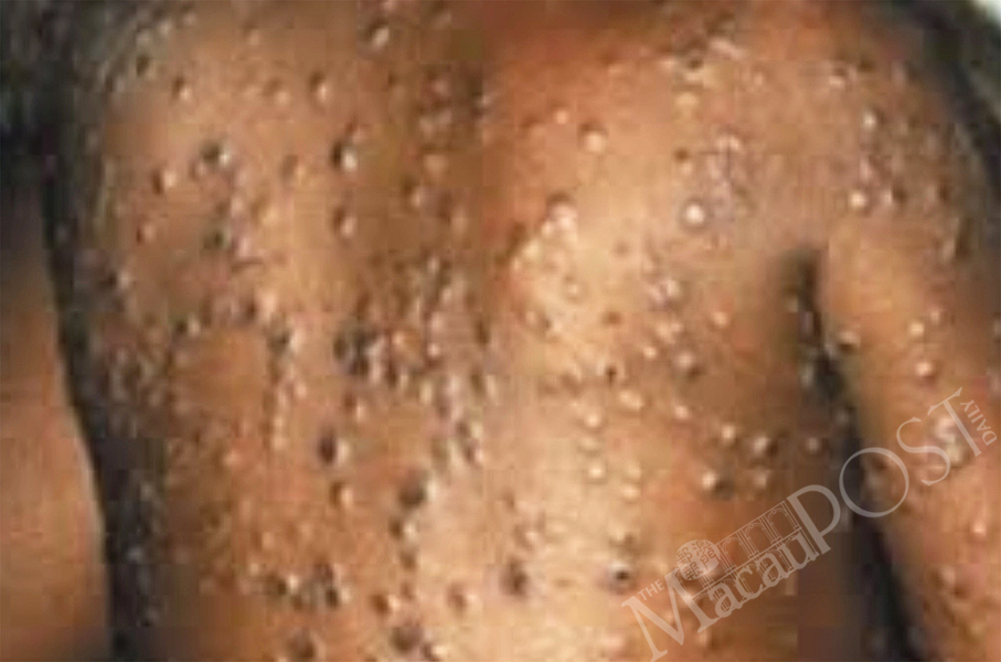 SSM says doctors must report monkeypox, patients to be isolated 