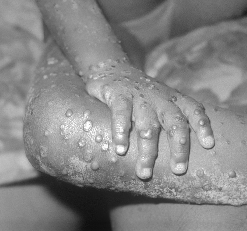 Macau legislature adds monkeypox to list of notifiable diseases