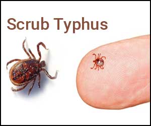 Local man diagnosed with scrub typhus: Health Bureau