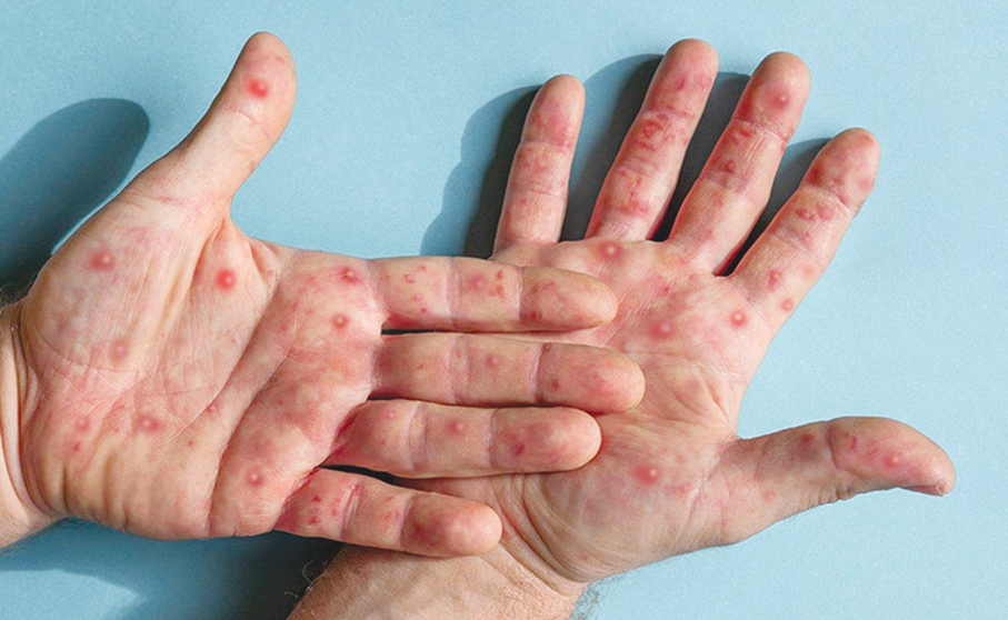 Macau logs 1st Mpox case: Health Bureau