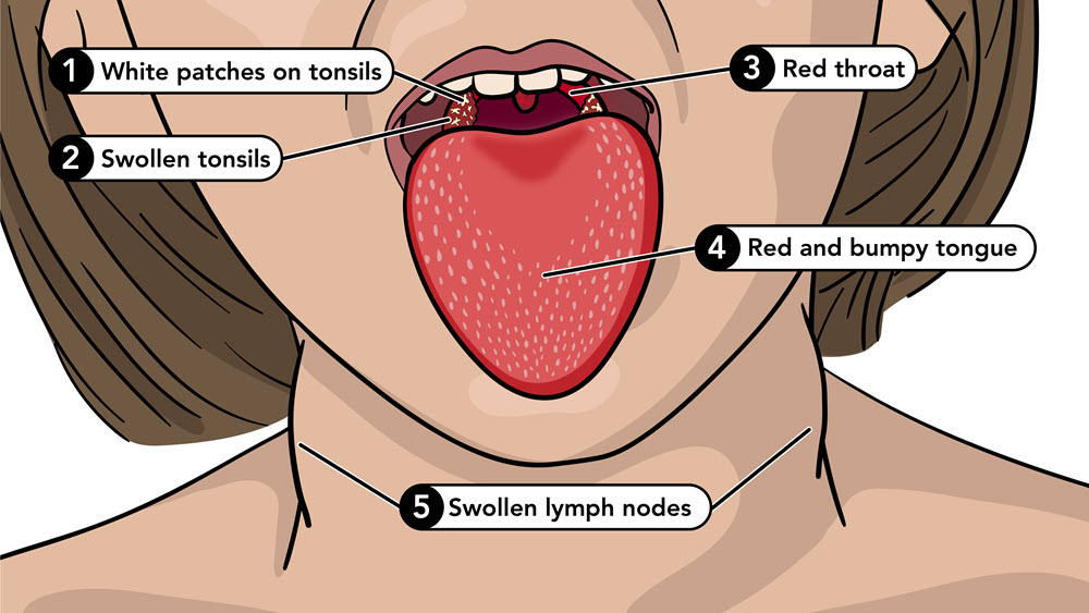 SSM urges public to beware of scarlet fever