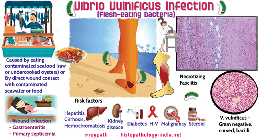 SSM records one more Vibrio vulnificus infection case; one critical COVID-19 case