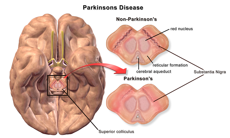 Parkinson’s possible to be blocked thanks to Chinese scientists’ breakthrough research