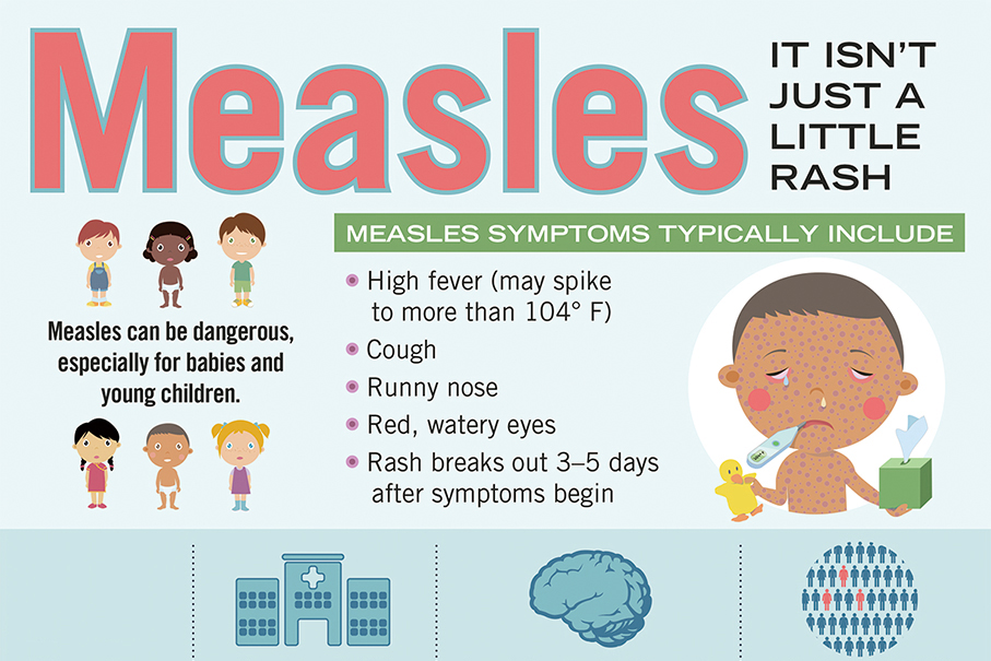 Govt urges residents to stay vigilant against measles