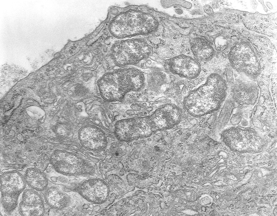 Health Bureau reports scrub typhus case